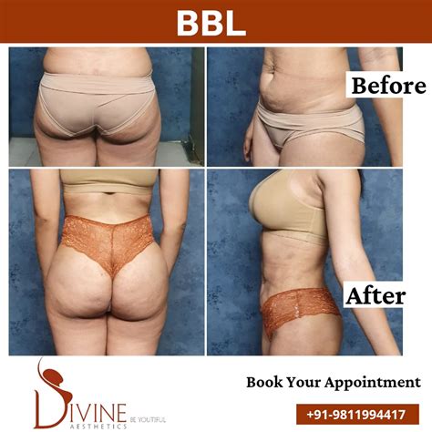 BBL-Before-After | The Brazilian buttock augmentation is a p… | Flickr