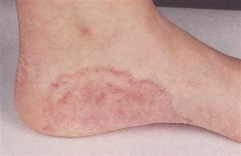 How to treat candida albicans – Artofit