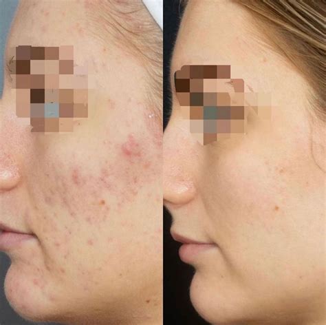 ACNE — Northern Skin Studio