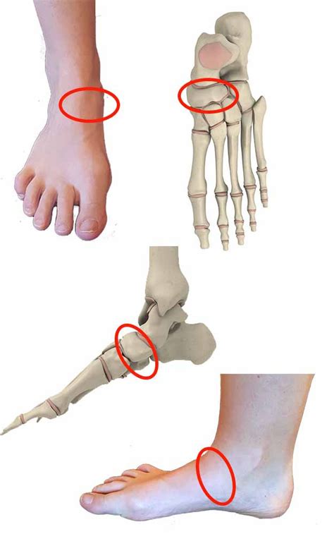 Navicular stress fractures – Symptoms and treatment