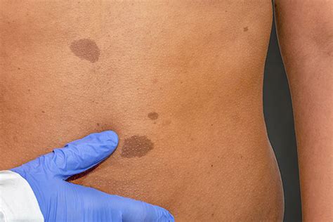 What Is NF? - Neurofibromatosis Northeast