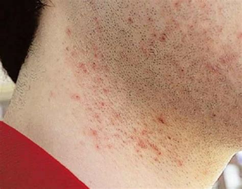 how to get rid of ingrown hair on neck men