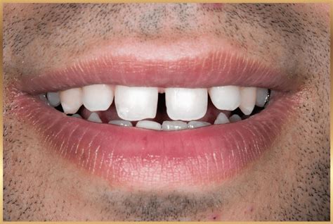 Dental gaps treatments - Kayla Medical Center