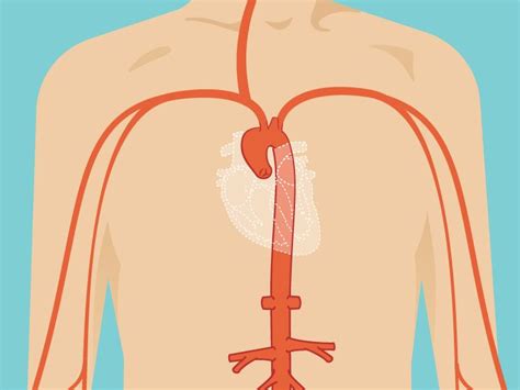 Ascending Aortic Aneurysm: Repair, Surgery, and Size Criteria