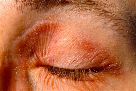 Eyelid Eczema (Eyelid Dermatitis): Symptoms, Causes, And, 51% OFF