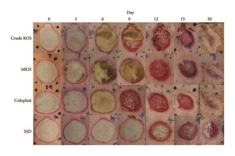 Phases Of Burn Healing