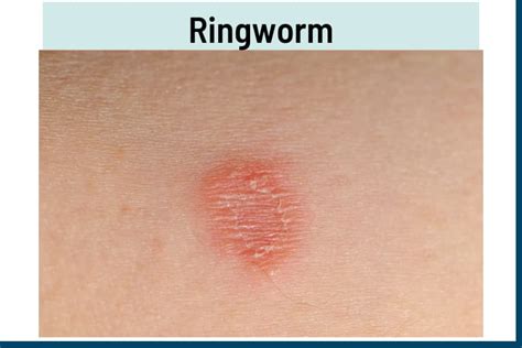 Treating Ringworm Like Rash at Lacey Chandler blog
