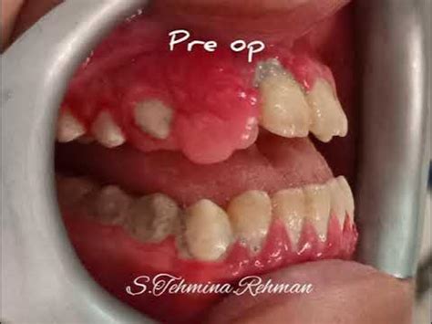 hyperplastic gingival growth resection youtube