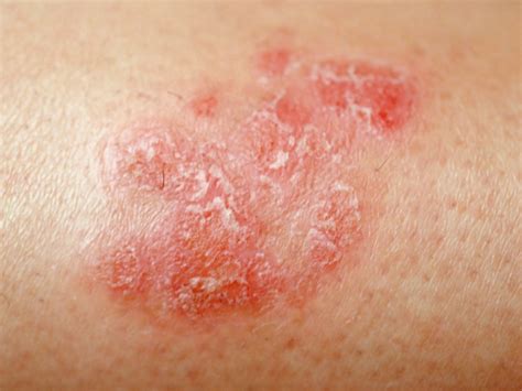 maladies de la peau psoriasis psoriasis   symptoms sclh