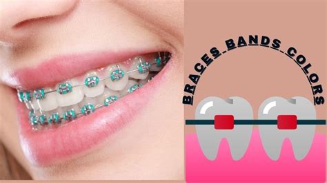 Ligatures And Inter-arch Band Colors For Braces