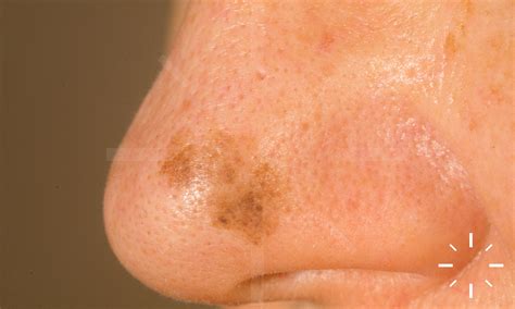 DermaCompass - Lentigo simplex, Lentigo solaris