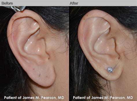 Earlobe Reduction - Dr. James Pearson Facial Plastic Surgery