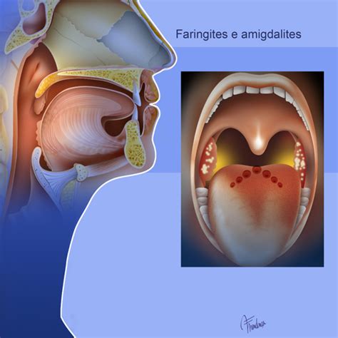 Laringite E Faringite - Saúde do Adulto: FARINGITE