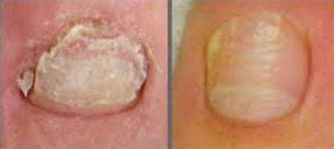 NAIL FUNGUS LASER TREATMENT