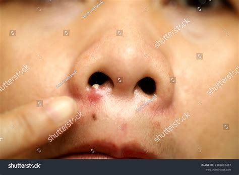 37 Pimples Inside Mouth Images, Stock Photos, 3D objects, & Vectors ...