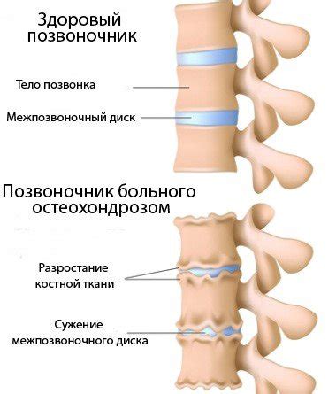 Остеохондроз Авторские статьи Клиники подологии Полёт в Москве