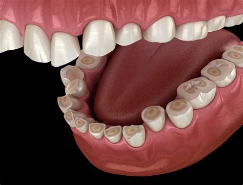 Causes of enamel erosion - Newbury Park Dentist