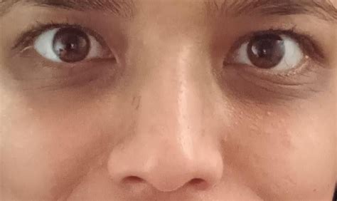 [Misc] Dermabrasion to reshape nose : r/SkincareAddiction