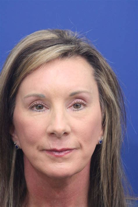 Endoscopic Brow Lift - Synergi Facial Surgery