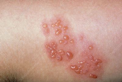 Shingles: close-up of blisters - Stock Image - M260/0083 - Science ...