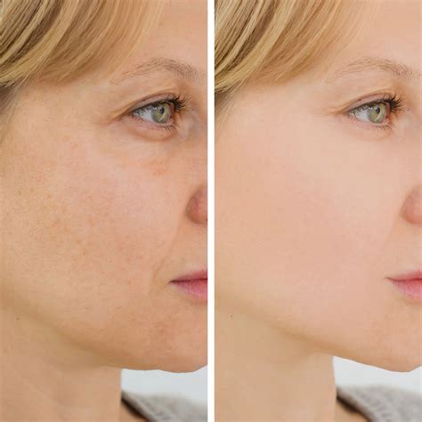 juvederm volux xc injectable filler santa rosa  healdsburg