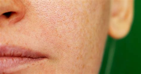 Melasma Treatment and Causes From Doctors | POPSUGAR Beauty