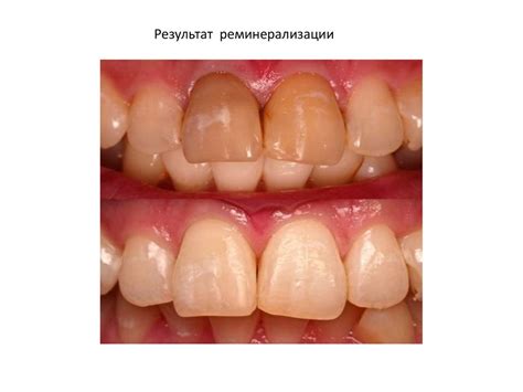 Синдром Стентона - Капдепона - презентация онлайн