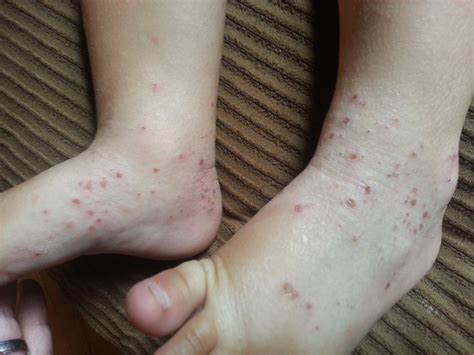 Impetiginous-Atopic-Dermatitis - The Medical Media Review