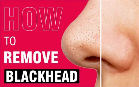 How to Get Rid Of Your Blackheads Tips By Dermatologist