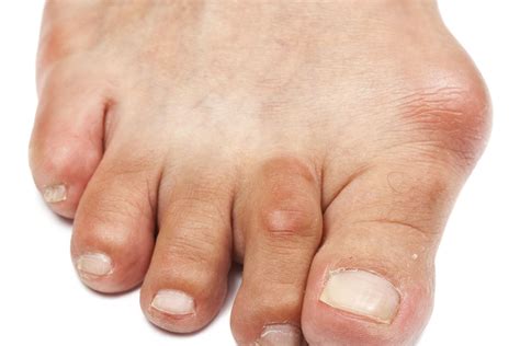 Common Types of Bunions