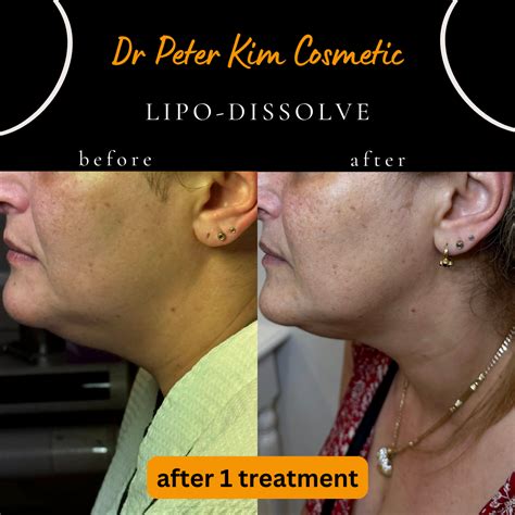 lipo dissolve fat dissolving injection dr peter kim surgery skin