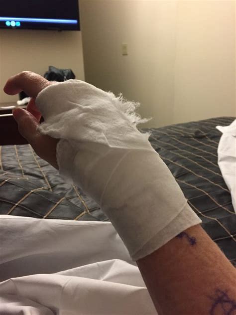 Ganglion Cyst Removal / Excision Recovery Pictures – Jenny Smith