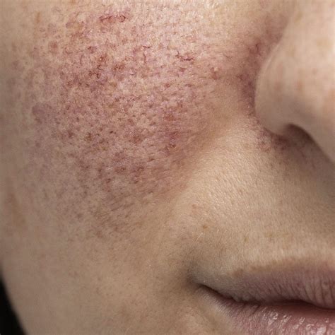 skin redness sensitivity nicola quinn spa