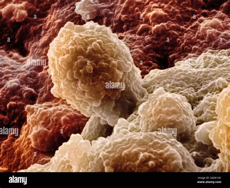 Las células de cáncer de próstata, color Micrografía análisis de ...