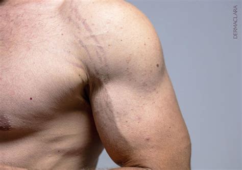 goodbye  doubts heres  real answers  gym stretch marks