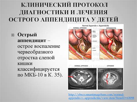 Острый аппендицит у детей - презентация онлайн