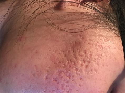 Cystic Acne Scars