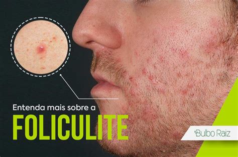 Foliculite O Que Causa - Foliculite Viral Foliculite Capilar: Saiba O Que Causa E Como Curar
