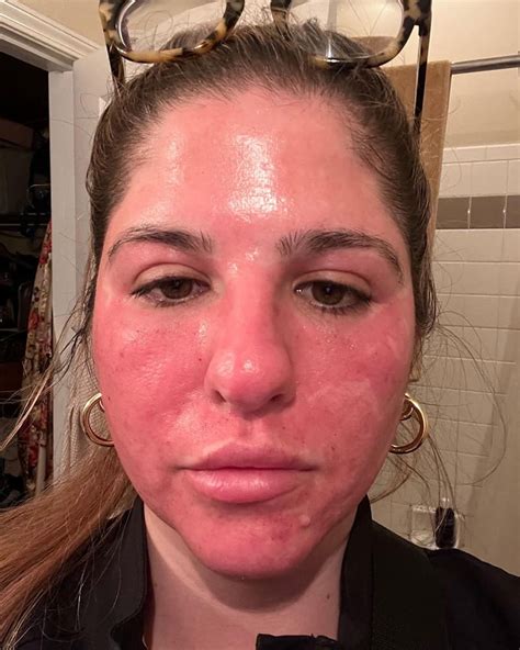 CO2 Resurfacing Laser: Before, During, After | RMA