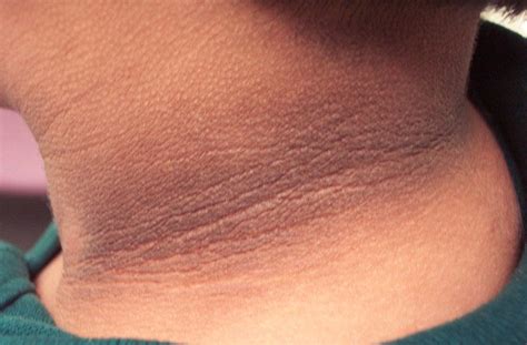 ACANTHOSIS NIGRICANS . Acanthosis... - Dr Zubaidi Hj Ahmad