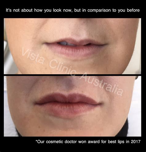 LIPS | BEFORE AND AFTER - Vista Clinic Melbourne