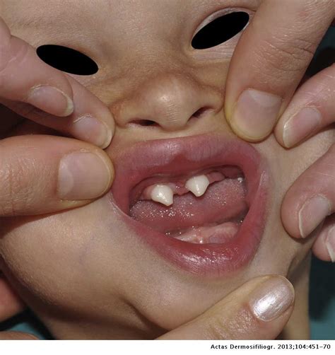 Ectodermal Dysplasia Teeth