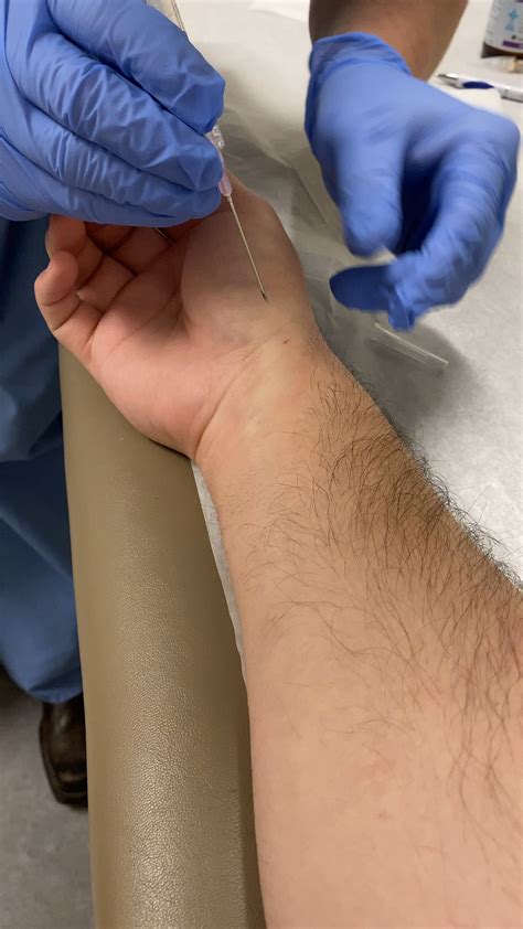 I just had my ganglion cyst aspirated. : r/PimplePoppersDelight