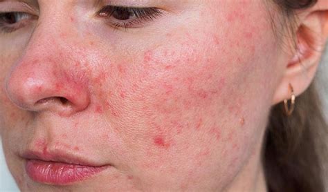 Rosacea - Zen Poliklinik