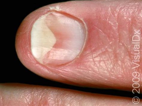 Onycholysis: Causes, Symptoms, and Treatment - Skinsight