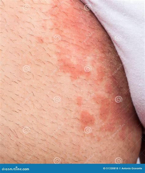 Eczema groin stock photo. Image of atopic, medicine, hives - 51330818