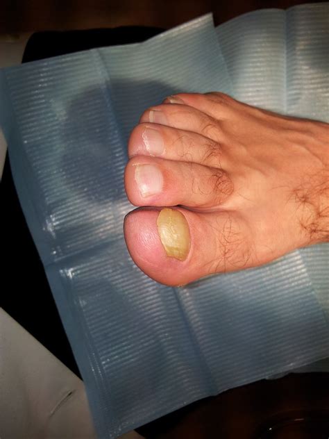 Clínica Trinitat: Podología y Fisioterapia: Traumatismos en las uñas