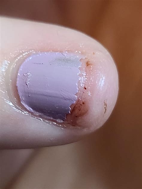 I ripped off part of my fingernail at work (pic 1), so I came up with a