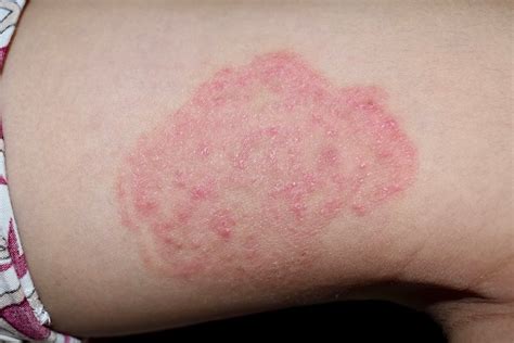 Чем лечить лишай у детей: мази и другие препараты | MedAboutMe