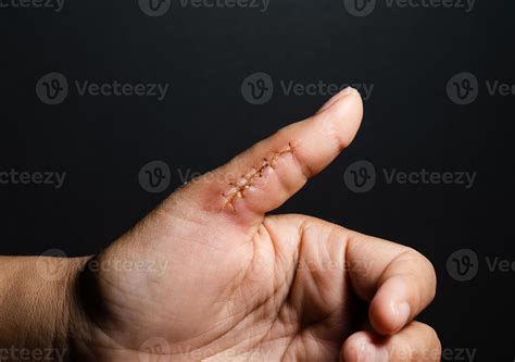 Why doctors are seeing more cases of thumb fasciculations now 10